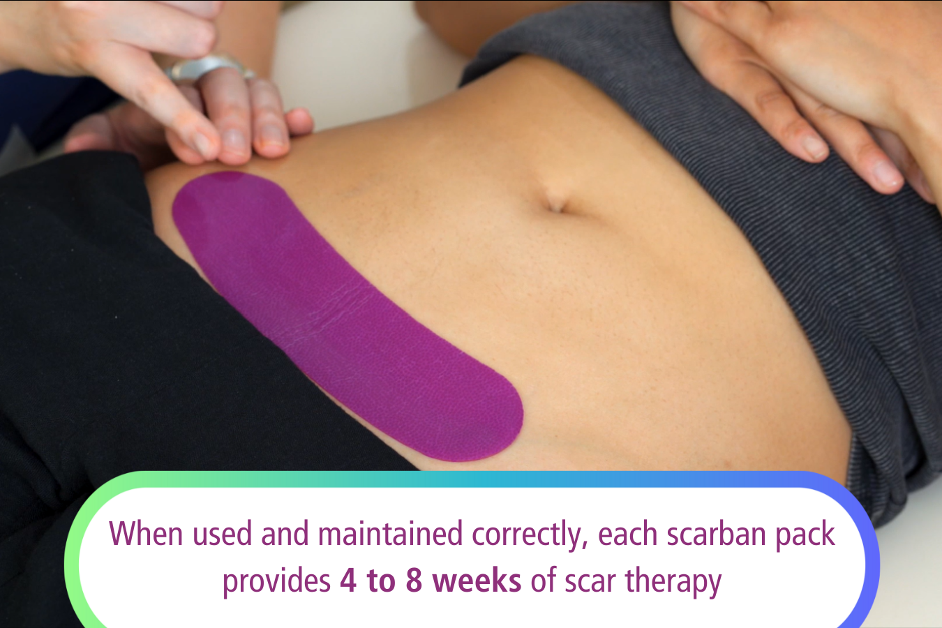 Application of Scarban C-section silicone sheet